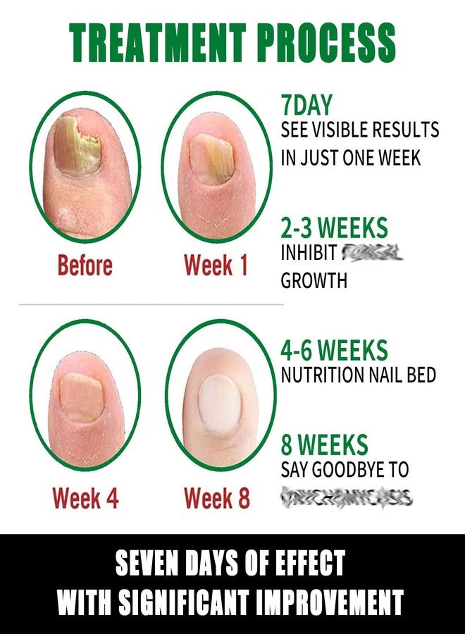 IMOLL Ginger Nail Treatment Nail Support Nail Care, 7days Nail Treatment, Ginger Nail Growth Serum, Ginger Cuticle Care Oil for Nails,Cuticle Serum for Nails (2Pcs, 1 Fl.oz(pack of 1)) - Image 4